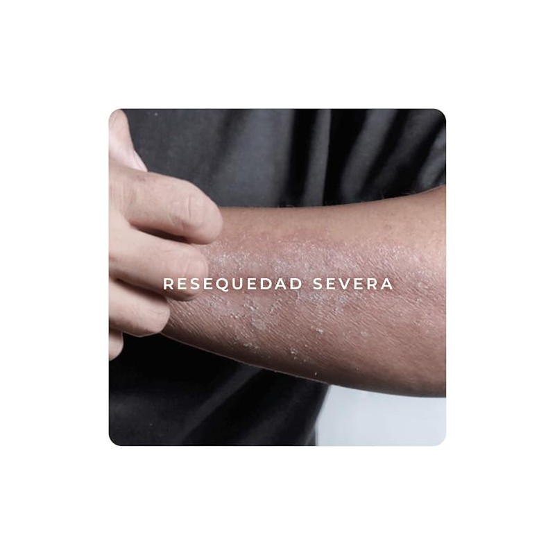 Derman DB Calm Crema Corporal Urea-D 10 Ácido Hialurónico 300