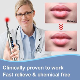Red Light Cold Sore Device, Cold Sore Treatment for Lips, Canker Sore Fever Blister Treatment, Red Light Therapy for Nose Face Cold Sore Removable Tip with LCD Display