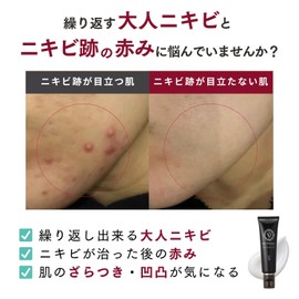 (For Redness of Acne Scars) Medicinal Cream Bellhatian 5+ (Acne Scars, Redness, Adult Acne, Acne Care), Active Ingredients, Hepalin Similar, Dicalysium Glycyrrhizinate, Vitamin C Derivative, Made in