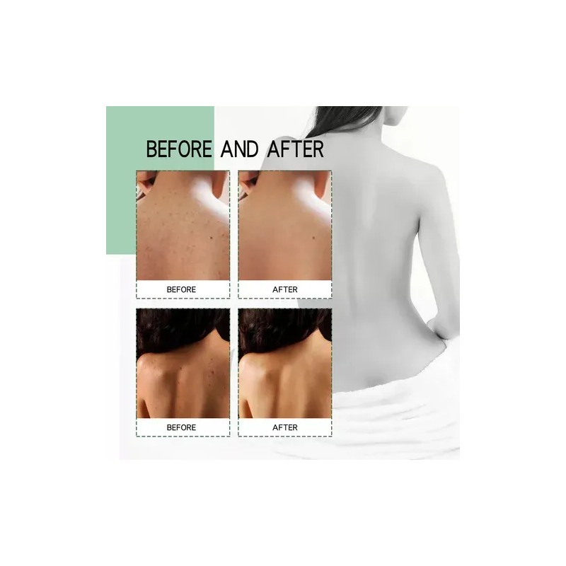 Acné De Espalda: Cura El Acné Corporal Con Ácido Salicílico