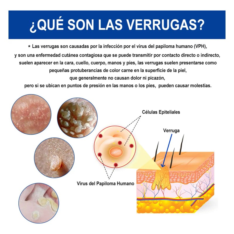 Líquido De Eliminación De Verrugas Plantar Y Comunes 1pc