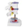 Human Size Medical Model - Anatomical Herniated Disc Demonstration Accessories