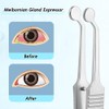 Meibomian Gland Expressor Forceps, Eyelid Gland Blockage Unblocking Physiotherapy Tools,