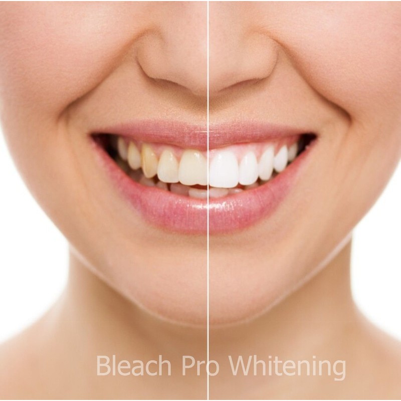 Teeth Whitening Kit 22% Carbamide Peroxide 10 Tooth Bleaching Gel
