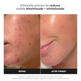 Paula's Choice Skin Perfecting - Líquido salicílico exfoliante 2% BHA, exfoliante facial para puntos negros, poros grandes, arrugas y líneas finas