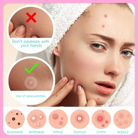 Pimple Patch for Face, Acne Patches Hydrocolloid with Tea Tree Oil, Salicylic Acid & Calendula Oil, 5 Size Invisible for Makeup Zit Patch Dots 210 pcs