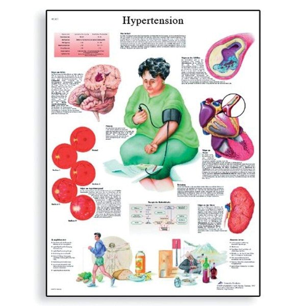 3B Scientific VR1361UU Glossy Paper Hypertension Anatomical Chart, Poster Size 20" Width x 26" Height