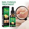 JAYSUING Ginger Nail Treatment Nail Support Nail Care - Specification: