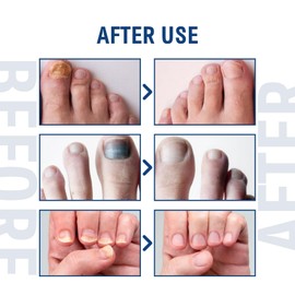 20ml Nail Treatment,Nail Treatment for Toenail Fingernails,Toenai-ls Extra Strong N-ail Treatment,Ingrown Toena-il Tre-atment,Protects Thick Broken and Discolored Nai-ls,Nai-l Care