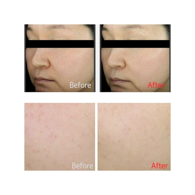 MEDITHERAPY Arbutin Skin Booster Serum with Boost Cap Package 5items