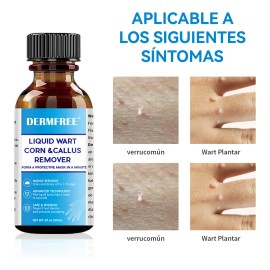 Líquida Eliminación De Verrugas,verrugas Plantare Y Comune