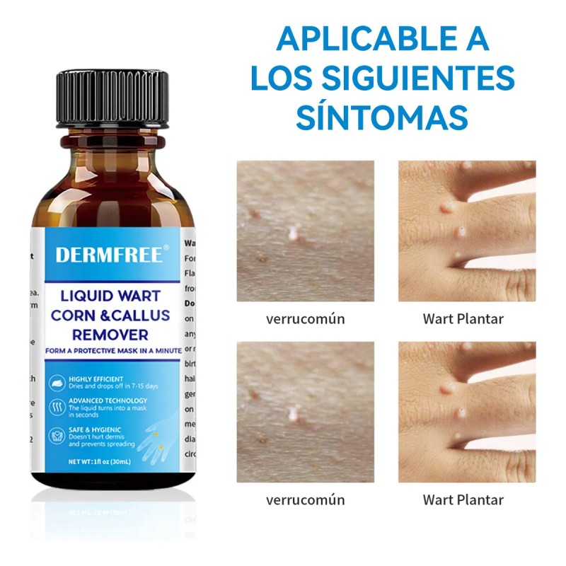 Líquida Eliminación De Verrugas,verrugas Plantare Y Comune