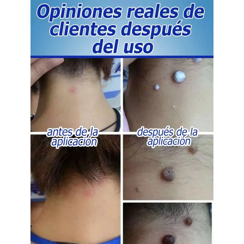 Crema Quitar Verrugas Genitales Efectiva 20g