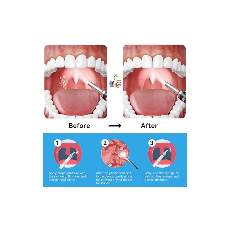 Upgraded Tonsil Stone Remover with Camera, Visual Tonsil Stone Removal