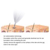 Professional Household Mole Removal Pen Dark Spots Freckle Remover Skin