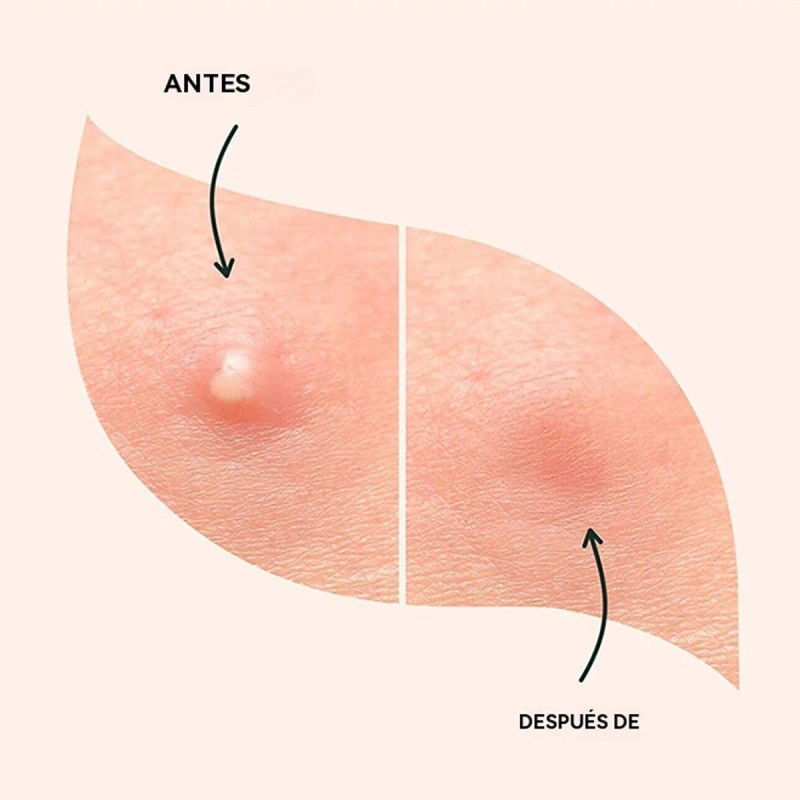 Parches Para Acne Granos Hidrocoagulante Para Espinillas Pim