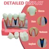 Windplusya Dental Implant Model 4 Times Implant Teeth Model, Analysis