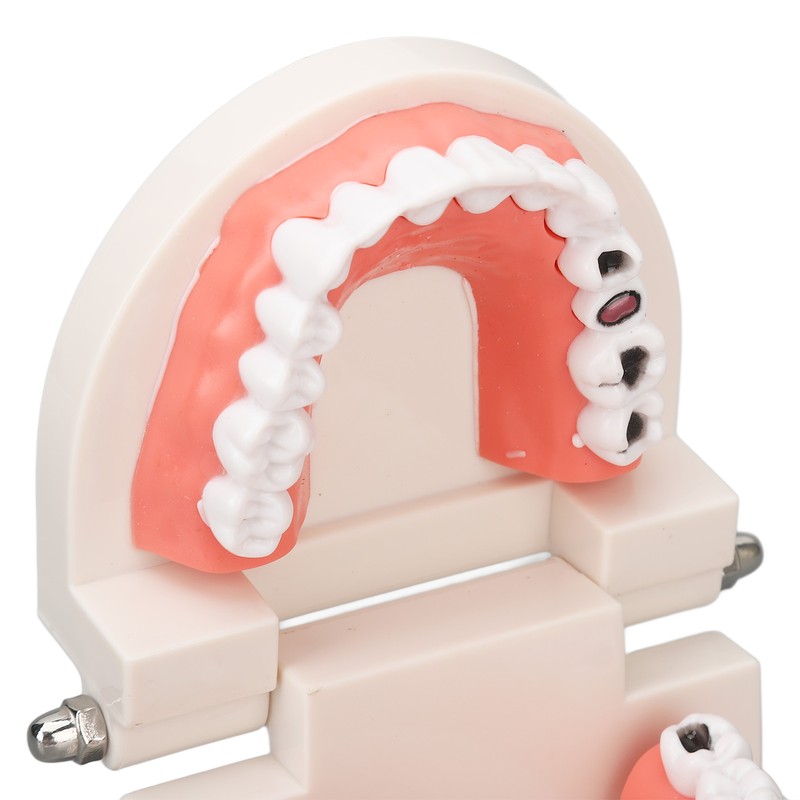 Dental Disease Caries Teeth Model Resin Simulation Teaching Prop Dental