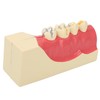 Right Lower Posterior Tooth Model 2X Magnification Detachable Resin Tooth