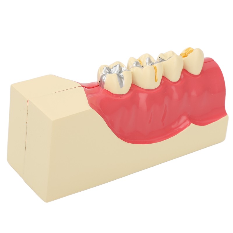 Right Lower Posterior Tooth Model 2X Magnification Detachable Resin Tooth