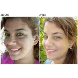 NEOPROSONE Serum Vitamina C Facial con Vitamina C al 20% y Alfa Arbutina, Tratamiento Despigmentante Aclarante Blanqueador, Hidrata y Trata Líneas de Expresión, 30 ML