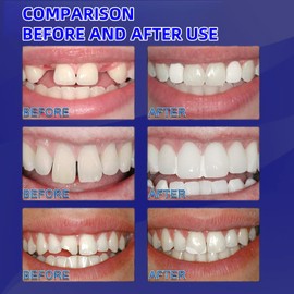 De/ntal Repair Kit,Temporary Tooth Filling,Home De/ntal Repair Kit for Repairing Lost Fillings,Tooth Filling Repair Kit for Fixing Broken,Teeth Repair & Replacement Kit,Missing Tooth Replacement Kit