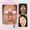 Crema Despigmentante Melasma Free 30ml Con Ácido Azelaico