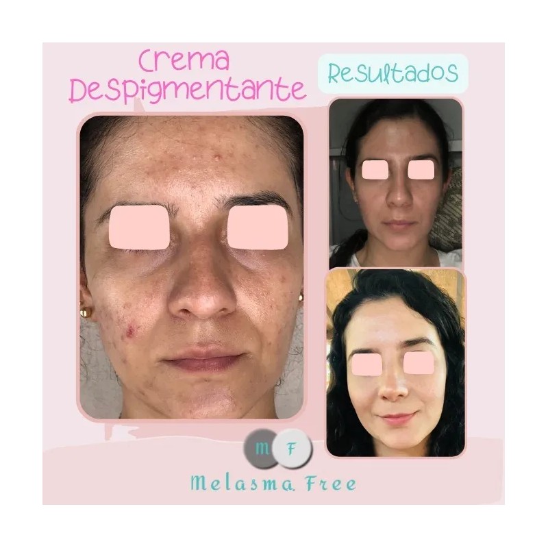Crema Despigmentante Melasma Free 30ml Con Ácido Azelaico