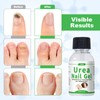 47% Urea Nail Gel – Medical-Grade Softening for Thick Toenails