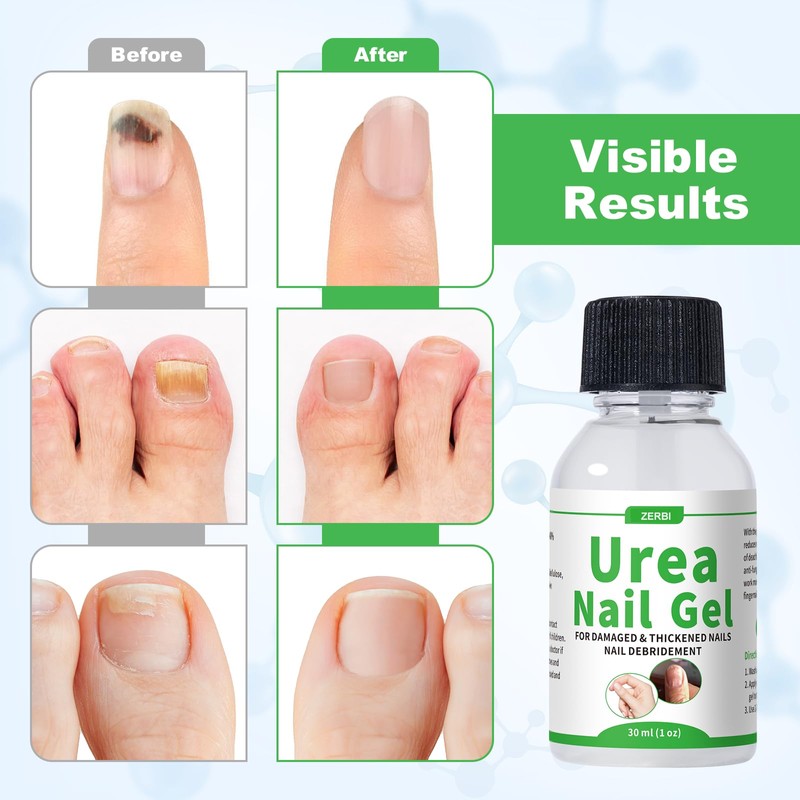 47% Urea Nail Gel – Medical-Grade Softening for Thick Toenails