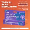 Benzoyl Peroxide Acne Treatment Gel 10% - 3 Pack