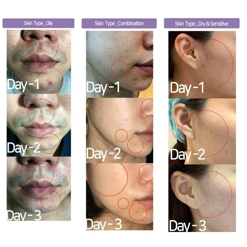 ACSEN AC Spot Solution, Concentrated Spot Serum, 72% Centella Asiatica
