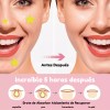 Parches Cuidado Facial Elimina Acné Espinillas Figuras 1016p