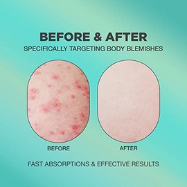PROOT- Crema para el acné en los glúteos | Crema para el acné en los glúteos y las imperfecciones del cuerpo | Crema para el acné en los glúteos formulada con fórmulas naturales