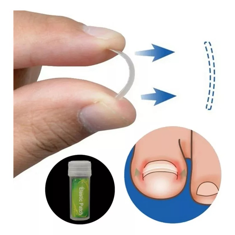 Universo en Linea Kit Corrección Uñas Enterradas Corrector Uñas Encarnadas