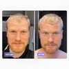 Scandinavian Biolabs Bio-Pilixin Activation Serum 100ml for Hair Loss for