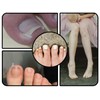 ZoeTekway Ingrown Toenails Set, Includes Ingrown Toenail Lifter Toenail Correction