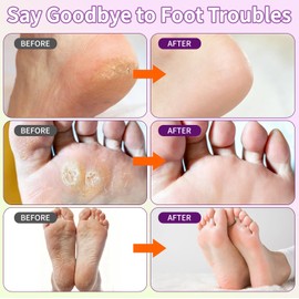 6 Pack Foot Peeling Mask, Foot Mask for Exfoliates Dead Skin & Tough Calluses, Softens Dry Cracked Rough Heels to Restore Baby Soft Feet, Feet Peeling Mask Gift for Men Women, Birthday & Anniversary