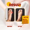 Kubbar The Foot Guru Soft Bunion Corrector & Protector