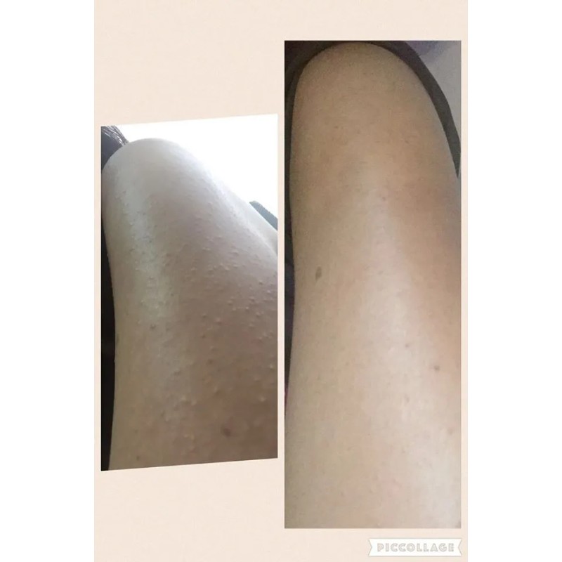 Crema Quera (queratosis, Psoriasis Y Eccema) 250 Gramos