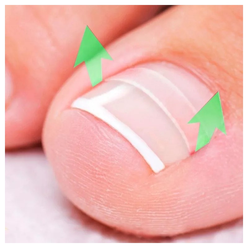 Universo en Linea Kit Corrección Uñas Enterradas Corrector Uñas Encarnadas