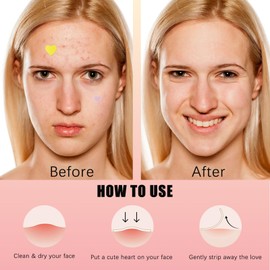 LuckyOpt 160 Stück Pickel Patches, Star-förmigen Anti Pickel Patches, Bunte Pickel Pflaster Hydrocolloid Patches für Gesichtspflege, 3 Größe (Liebe)