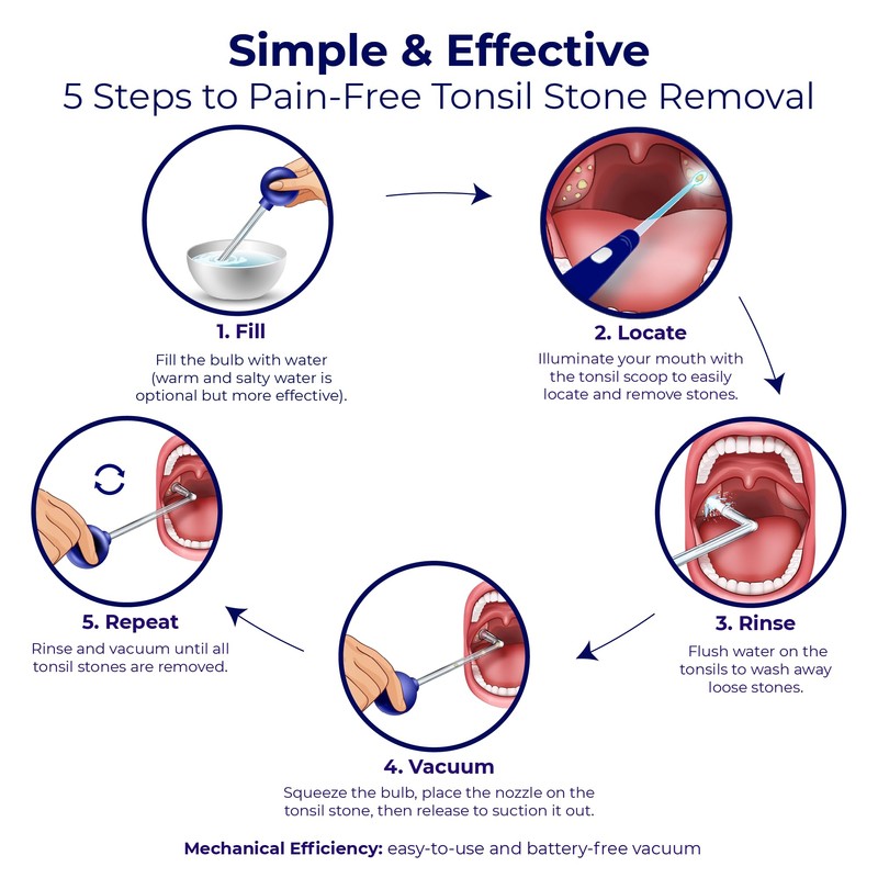 Oravix Tonsil Stone Vacuum, Tonsil Stone Remover Vacuum Suction, Tonsil