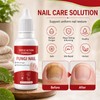 2PCS Fungi Nail ToenailTreatment,Gentle Formula,Effectively lmproves Nails for a More