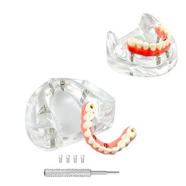 All-On-4 - Modelo de implantes dentales de mandíbula inferior, modelos de dientes de puente Malone, modelo de dientes de sobredentadura dental con implantes de reacondicionamiento