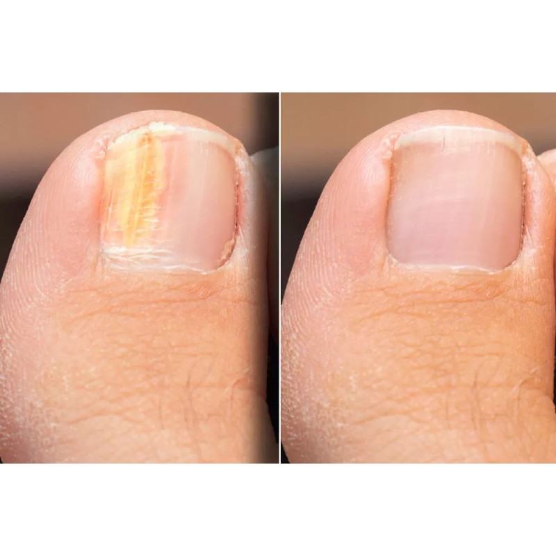 Vite 20 Brush On Kill Fungus - Maximum Strength 0.5