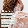 Dove Body Wash Acne Clears & Helps Prevent Acne Tratamiento