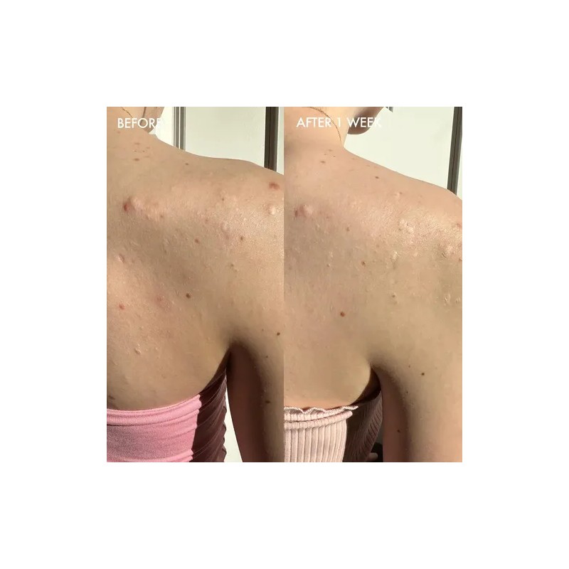 Jabón En Barra Dermisa Con Azufre Y Aloe Vera, Ayuda
