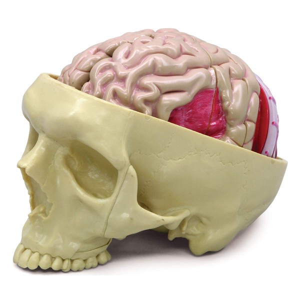 GPI Anatomicals - Brain Model, Replica of a Brain Inside a Partial Skull Afflicted by Pathologies for Human Anatomy and Physiology Education, Anatomy Model for Doctor's Office, Medical Study Supplies
