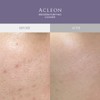 Acleon Anasis Mildly Alkaline Cleansing Foam Acne Treatment 2 Types